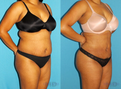 Brazilian Butt Lift case #4676