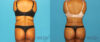 Brazilian Butt Lift case #4676 slider thumbnail
