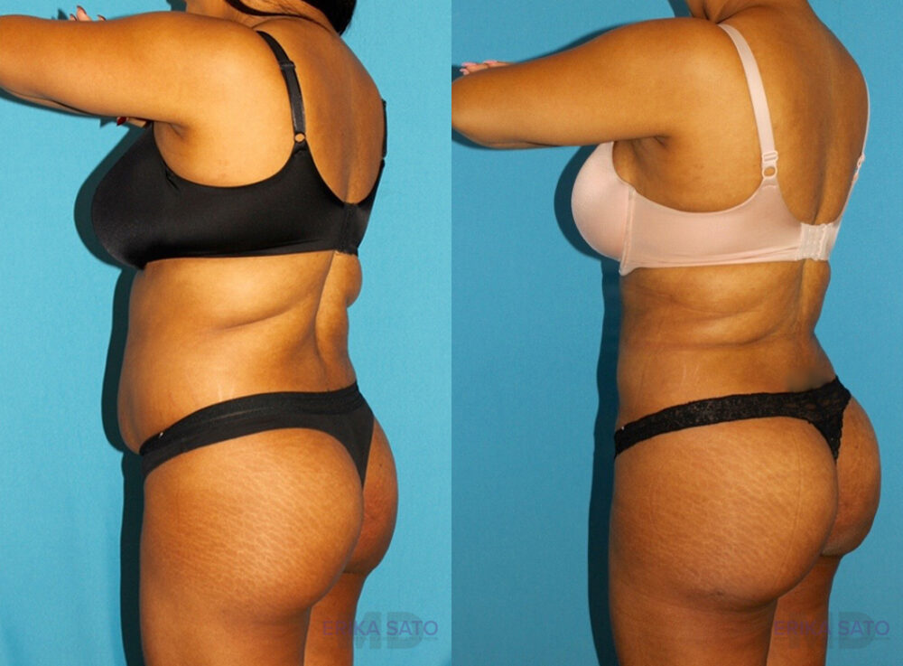 Brazilian Butt Lift case #4676