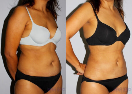 Liposuction case #5835