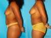 Mommy Makeover case #6509 slider thumbnail