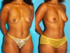 Mommy Makeover case #6509 slider thumbnail