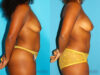 Mommy Makeover case #6509 slider thumbnail