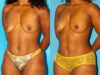 Mommy Makeover case #6509 slider thumbnail