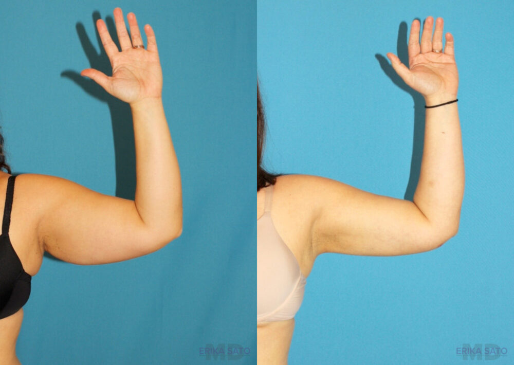 Liposuction case #5895
