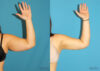 Liposuction case #5895 slider thumbnail