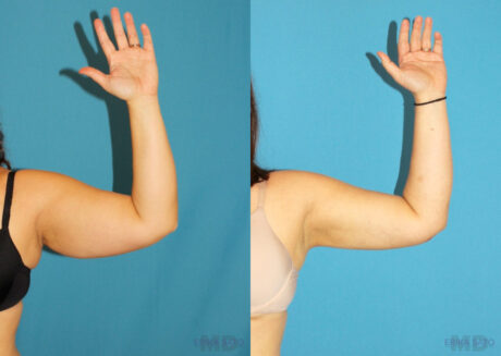 Liposuction case #5895
