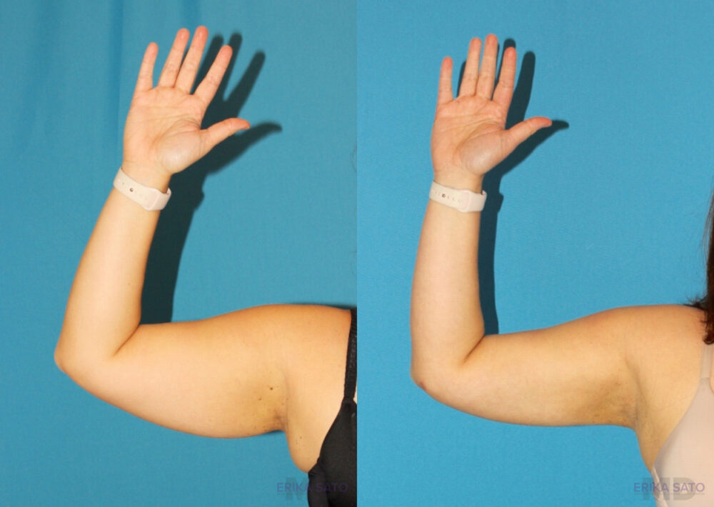 Liposuction case #5895