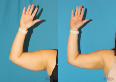 Liposuction case #5895