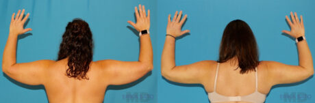 Liposuction case #5895