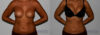 Liposuction case #5833 slider thumbnail