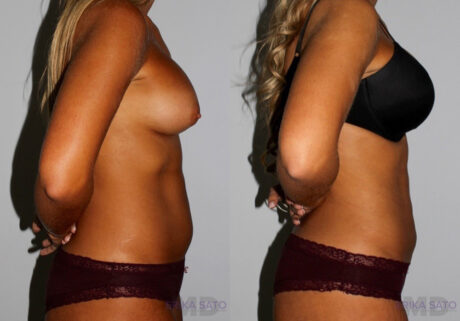 Liposuction case #5833