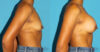 Breast Augmentation case #6256 slider thumbnail