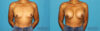 Breast Augmentation case #6256 slider thumbnail