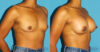 Breast Augmentation case #6256 slider thumbnail