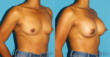 Breast Augmentation case #6256