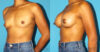 Breast Augmentation case #6256 slider thumbnail
