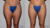 Liposuction case #5832 slider thumbnail