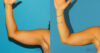 Liposuction case #5960 slider thumbnail