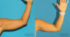 Liposuction case #5960 slider thumbnail