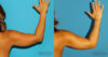 Liposuction case #5960 slider thumbnail