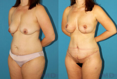 Mommy Makeover case #6510