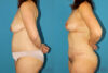 Mommy Makeover case #6510 slider thumbnail