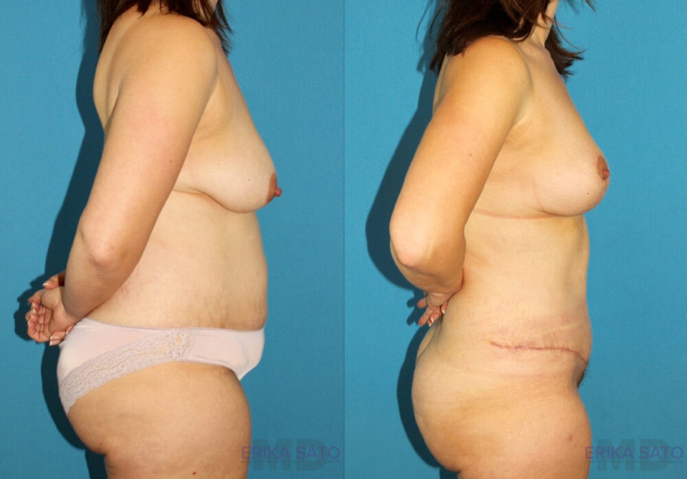Mommy Makeover case #6510