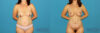 Mommy Makeover case #6510 slider thumbnail