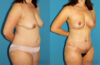 Mommy Makeover case #6510 slider thumbnail