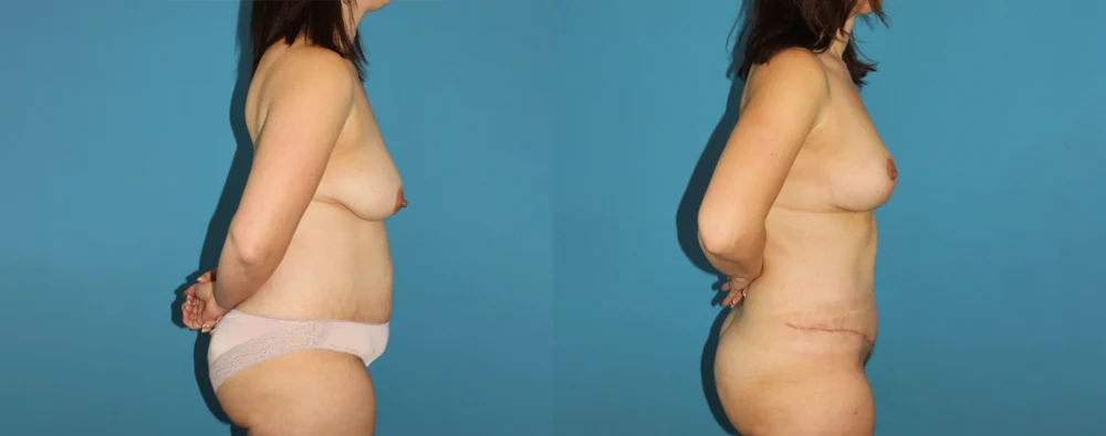 Mommy Makeover case #6510
