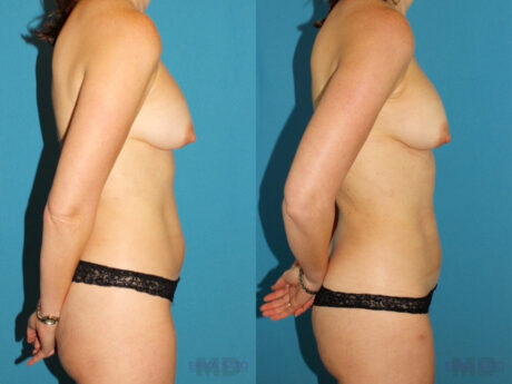 Liposuction case #5961