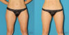 Liposuction case #5961 slider thumbnail