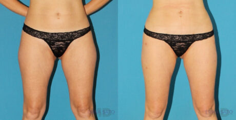 Liposuction case #5961