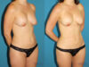 Liposuction case #5961 slider thumbnail