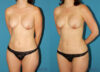 Liposuction case #5961 slider thumbnail