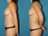 Liposuction case #5961 slider thumbnail