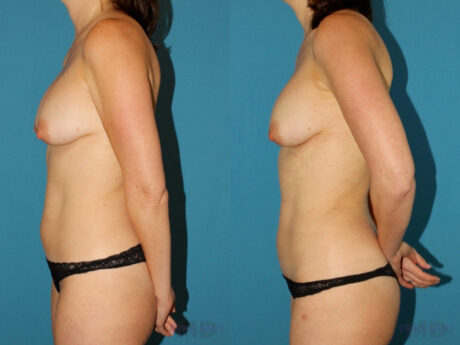 Liposuction case #5961
