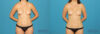 Liposuction case #5961 slider thumbnail