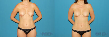 Liposuction case #5961