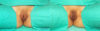Labiaplasty case #5752 slider thumbnail