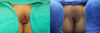 Labiaplasty case #5754 slider thumbnail