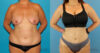 Liposuction case #5964 slider thumbnail