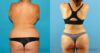 Liposuction case #5964 slider thumbnail