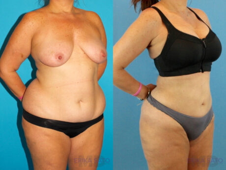 Liposuction case #5964