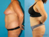 Liposuction case #5964 slider thumbnail