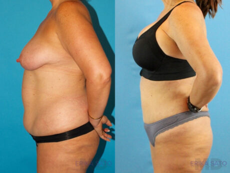 Liposuction case #5964