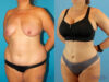 Liposuction case #5964 slider thumbnail
