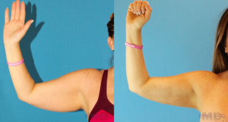 Liposuction case #5963