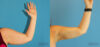 Liposuction case #5963 slider thumbnail